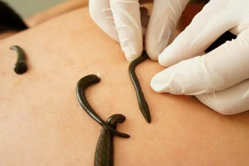 Leech Therapy / Jalaukavacharan