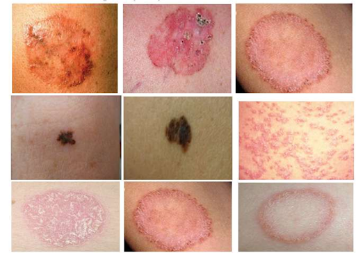 Skin Diseases